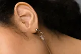 Ear Lobe Repair