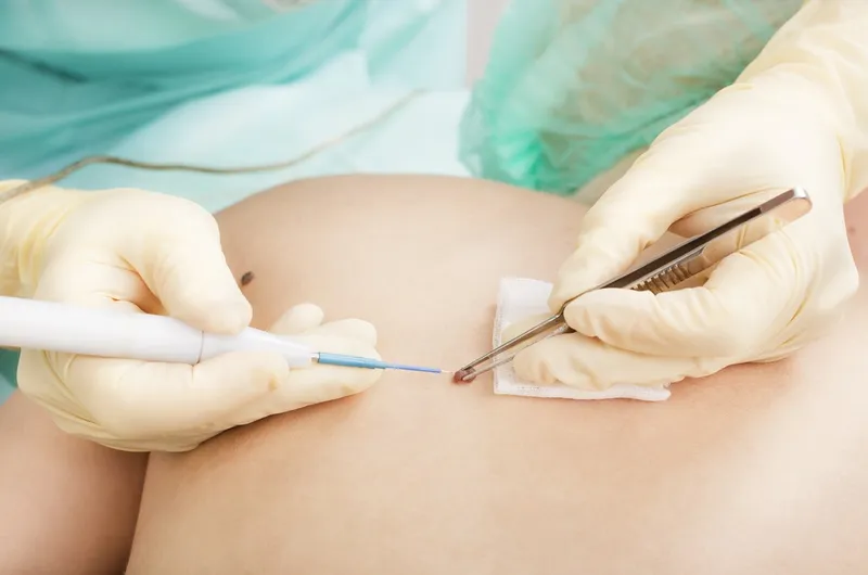 Skin Tag & Wart Removal